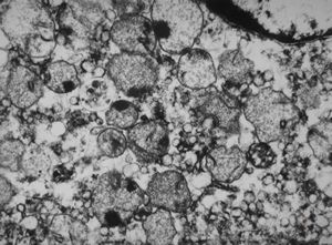 M, | newborn mitochondrial cardiomyopathy … autopsy sample from liver